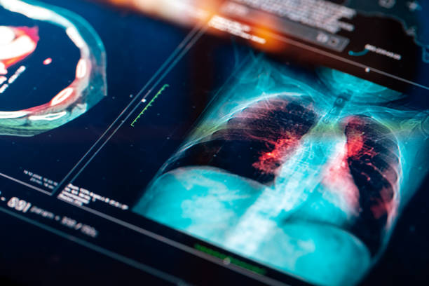 El tumor que sigue marcando la alerta sanitaria en España